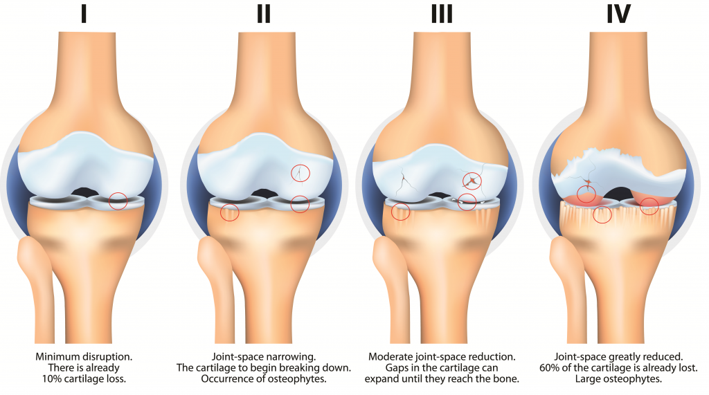 Osteoarthritis Condition Osteoarthritis Condition