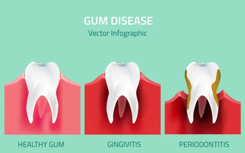 How Gum Disease Affect Your Overall Health