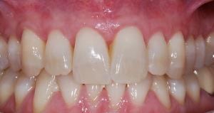 Receding Gums