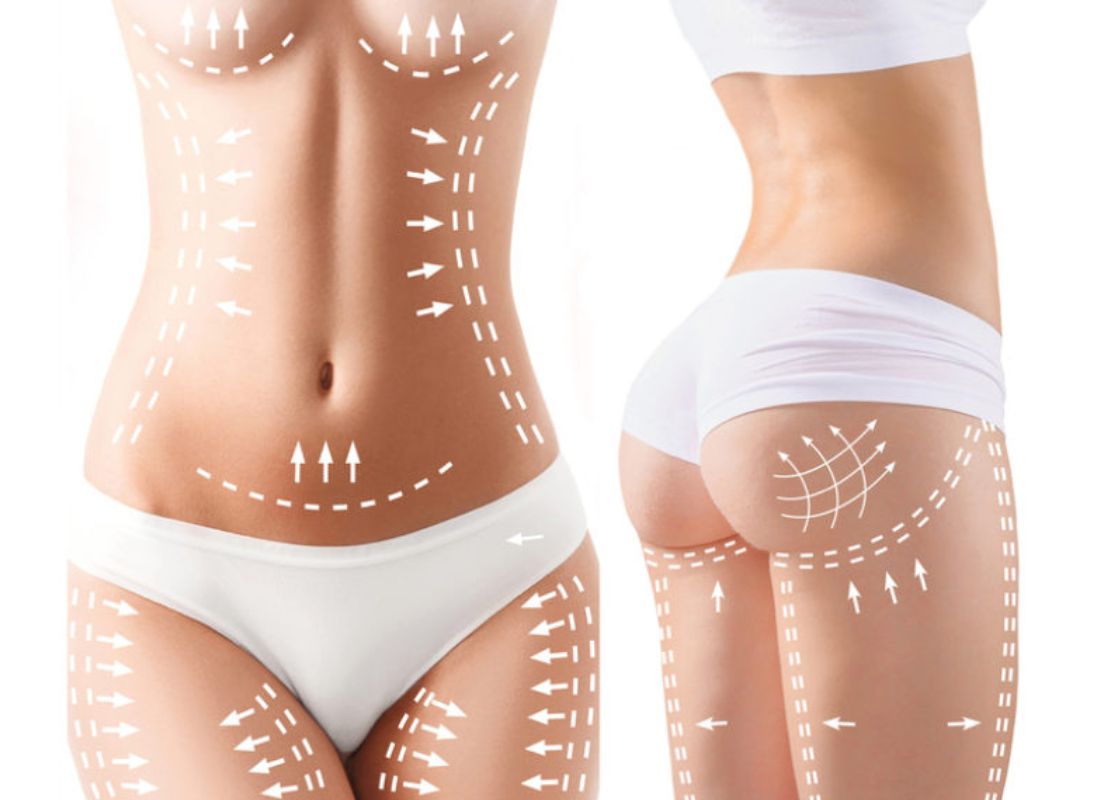 Surgical Body Contouring