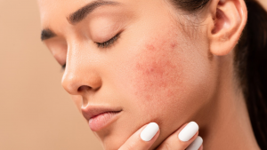 How to Get Rid of Acne Scars Naturally