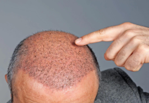 What A Hair Transplant Process Entails